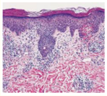 Figure 7: Pityriasis rosea delineating mild acanthosis, parakeratosis, hyperkeratosis, spongiosis, epidermal hyperplasia and an
intense, upper dermal inflammatory infiltrate [15].