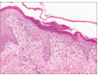 Figure 8: Pityriasis rosea exemplifying mild acanthosis, parakeratosis, hyperkeratosis, spongiosis and a moderate, upper dermal
infiltrate [16].