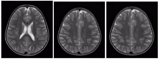 Figure 10: Follow up brain MR scan 6 months postoperatively.
Unremarkable brain MRI, no abnormal enhancement or
evidence of brain metastasis.