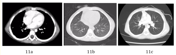 Figure 11a-11c: Follow up chest CT scan 6 months (a and b),
and 3 years (c) postoperatively. No definite residual or
recurrent soft tissue mass at the site of previous
pleuropulmonary blastoma could be appreciated in these
exams.