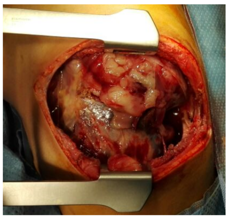 Figure 3: Intraoperative demonstration of a large fungating
right lung mass.