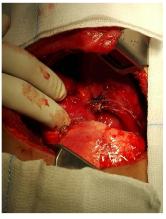 Figure 4: Following excision of the middle lobe mass,
illustration shows resection margin on the remaining right
upper and lower lung lobes.