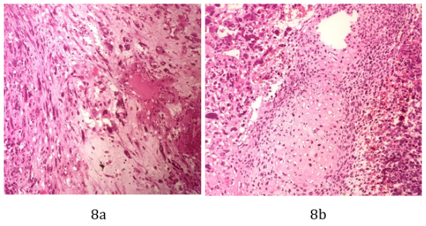 Figure 8a and 8b: Sections show a malignant tumor composed
of premetive blastema like cells with hyperchromatic nuclei,
high nucleocytoplasmic ratio and abundant mitosis. The spindle
cells are embedded in myxoid stroma (a). Groups of immature
chondroid elements (b).