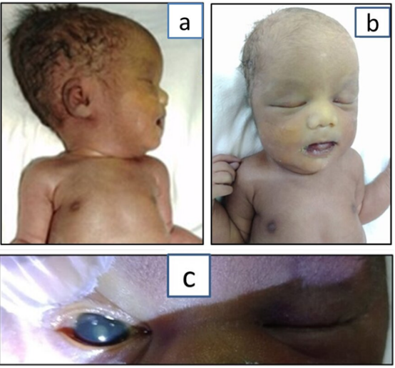 Figure 1: Figure 1A to 1C depicts facial features of the child. 1ANeonate with lateral facial profile. 1B-Frontal facial profile of the
neonate. 1C-Congenital cataract.