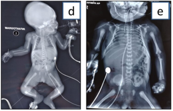 Figure 2: Figure 2A and 2B depicts skeletal features. 2A-Infantogram with normal long bones. 2B-Narrow thorax.