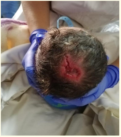 Figure 1: A 3.0 × 2.3 cm skin defect on scalp vertex.