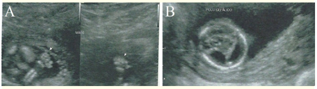 Figure 1: In A, ultrasonography demonstrating polydactyly in the
hands. In B, ultrasonography displaying the lack of characterization of the midline anatomy of the central nervous system.