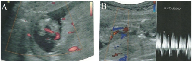 Figure 2: In A, ultrasonography demonstrating an umbilical cord
with a single umbilical artery. In B, ultrasonography displaying
wave reversed to the Doppler study of the ductus venosus.