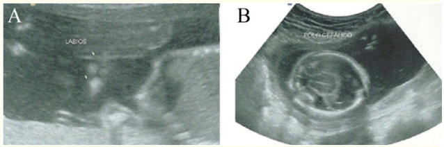 Figure 3: In A, ultrasonography demonstrating facial dysmorphism (bilateral cleft lip). In B, ultrasonography displaying holoprosencephaly and microcephaly in B.