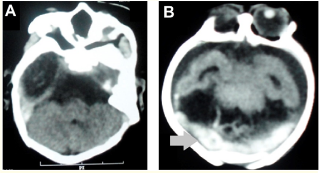 Figure 4: Head CT in the axial section in A and B demonstrating dilation of the systems ventricular without septum pellucid
characterization (alobar holoprosencephaly), increase of the
subarachnoid space and absence of cortical gyri (lissencephaly)
and blood bordering the cerebellar hemispheres (gray arrow).