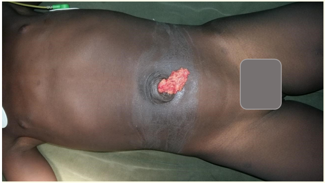 Figure 2: Umbilical wound with epiplocele on front view before
the operation.