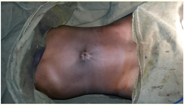 Figure 3: Umbilical aspect in front view after surgery.