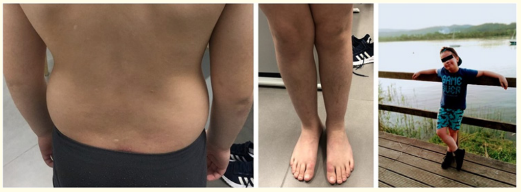 Figure 2: Patient after dupilumab treatment, showing dramatically improvement in his eczema.