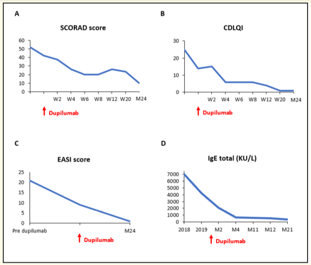 Figure 3: A, B: Standardized Scoring of Atopic Dermatitis (SCORAD) and Children´s Dermatology Life Quality Index (CDLQI) scores at dupilumab initiation and at multiple time points on treatment. C: Eczema Area and Severity Score (EASI) score before, at dupilumab initiation and at month 24. D: Serum IgE levels before dupilumab initiation and at multiple time points on treatment.