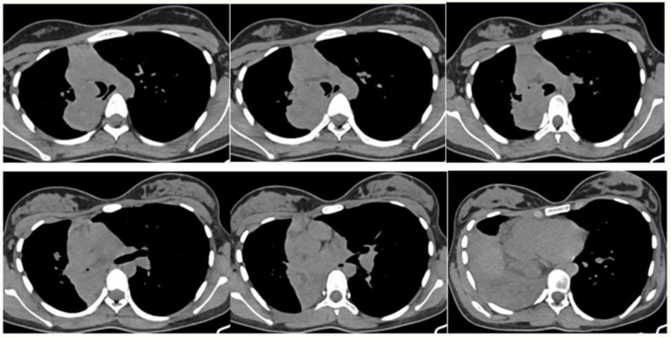 Figure 2: Axial (A-F) Non-contrast Computed Tomography images show a multilobulated isodense mass in the distal trachea extending to the right lower lobe bronchus with significant extraluminal component causing abrupt cut off of the bronchus intermedius causing lower lobe collapse.