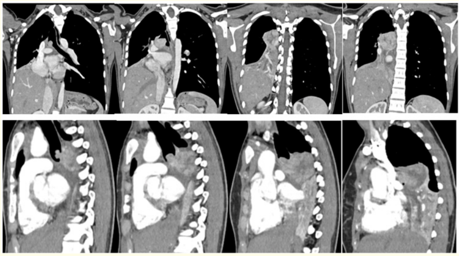 Figure 4: Reconstructed Coronal (A-D) and Sagittal (E-H) Contrast enhanced Computed Tomography images reveal multilobulated endotracheal and right endobronchial tumour occluding the right main brochus.