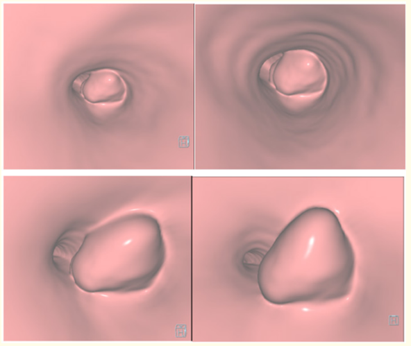 Figure 5: Computed Tomography Virtual Bronchoscopy (A-D) images exhibit lobulated tumor arising from the right main bronchus, occluding lumen , projecting into carina & lower trachea.