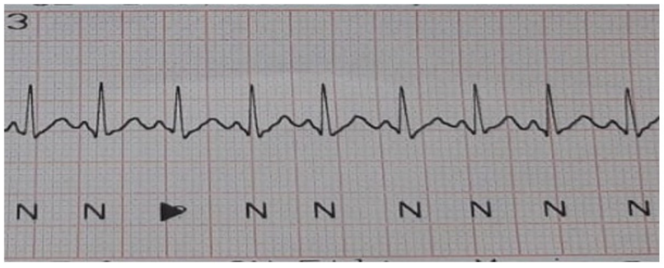 Figure 1: ECG of the Child in the early phase. <br> Sinus Tachycardia.