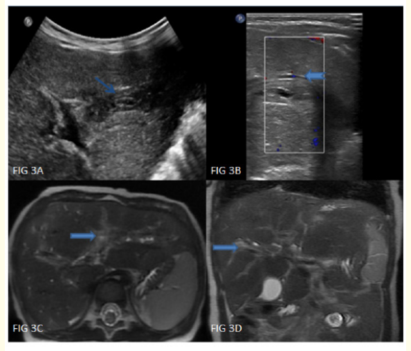 Figure 3: A-D: High resolution ultrasonography showing mild prominence of intrahepatic biliary radicles (notched arrows) with diffuse periportal hypoechogenicity in both lobes of liver (arrows). MRI demonstrates hepatomegaly with diffuse T2 hyperintense periportal cuffing in both lobes of liver (thick arrows).