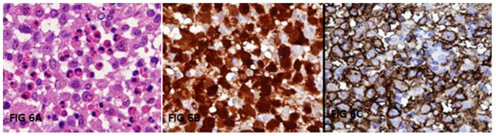 Figure 6: A-C: On histopathological examination, large polygonal cells with round to oval nuclei and indistinct cytoplasm with surrounding inflammatory infiltrate composed of predominantly eosinophils were seen (6A). On Immunohistochemistry (IHC), CD1a and S-100 were positive in many of the large cells (6B and C).