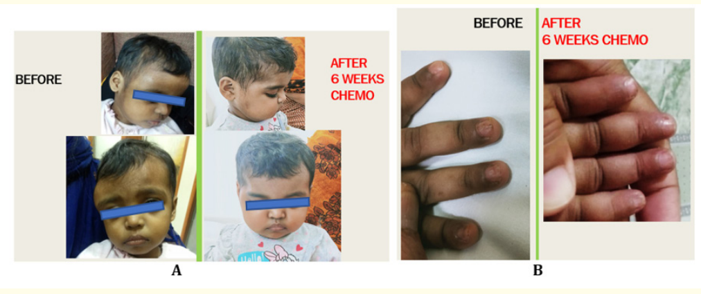 Figure 9: A: Complete clinical resolution of supraorbital lesion after 6 weeks of chemo. B: Improvement of nail changes after 6 weeks of chemo.