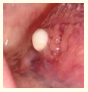 Figure 1: Oral lympho-epithelial cyst depicting a yellowish pouch imbued with keratin and desquamated epithelium [12].