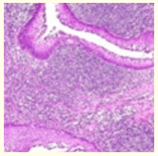 Figure 4: Oral lympho-epithelial cyst exhibiting a cystic cavity layered with pseudo-stratified squamous epithelium and a circumscribing lymphoid stroma [14].