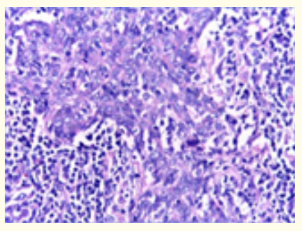 Figure 5: Oral lympho-epithelial cyst exemplifying islands of stratified squamous epithelium surrounded by extensive lymphoid tissue [15].