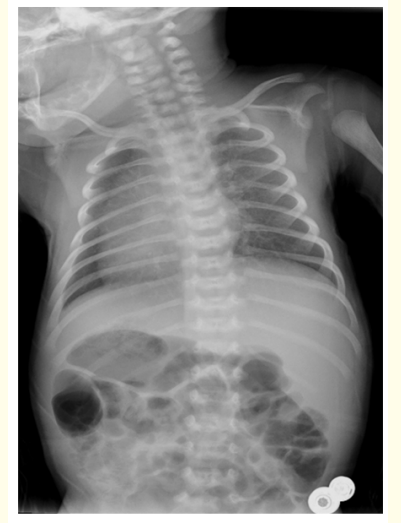 Figure 1: Chest X-ray showing total situs inversus.