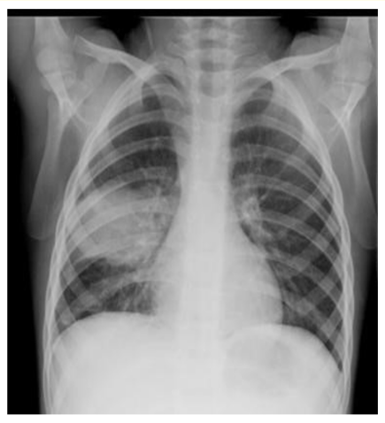 Figure 2: Right middle lobe pneumonia.