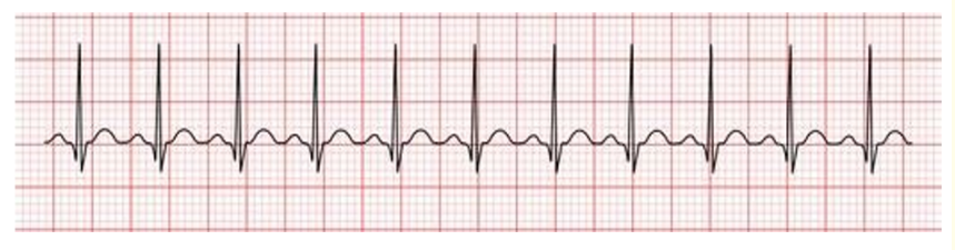 Figure 3: Sinus tachycardia with pulseless electrical activity (PEA).