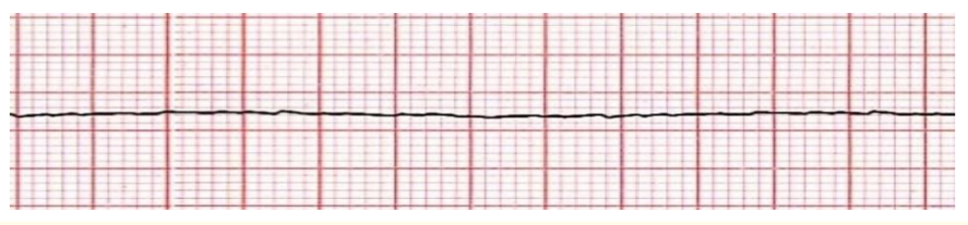 Figure 4: Cardiac asystole.