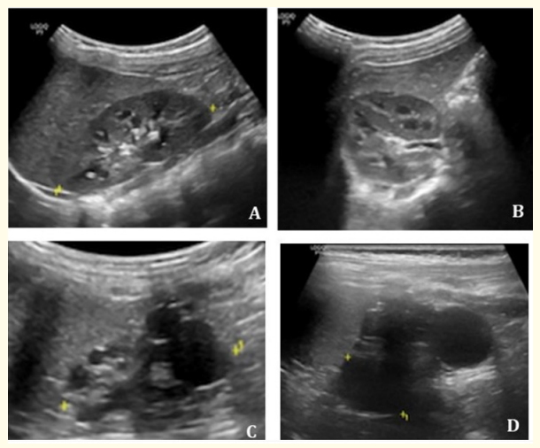 Figure 1: Renal ultrasound performed on the third day-of-life, showing multiple renal cysts, the largest marked by yellow points in the image, with 43 x 28mm.