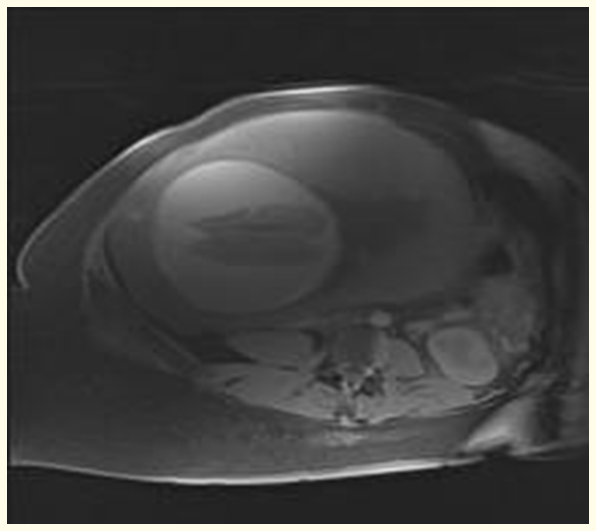 Figure 1: Feta MRI T1 image showing bilateral large subacute subdural hematoma.