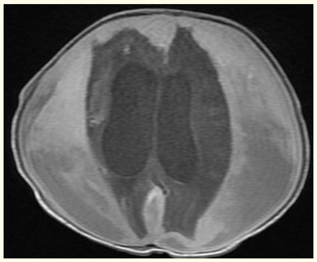 Figure 2: Postnatal MRI brain T1 image showing subdural, intracerebral, intracerberral and intraventricular hemorrhages with supratentorial hydrocephalus.