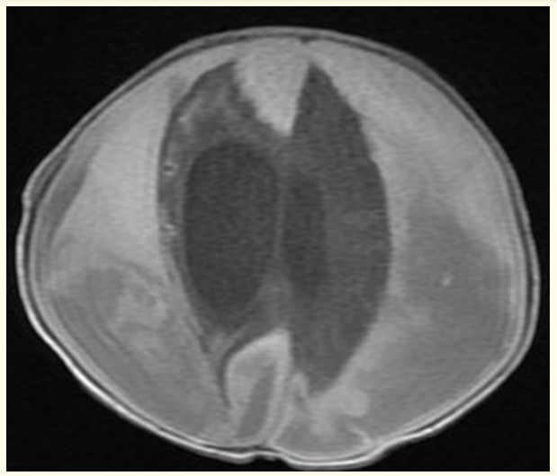 Figure 3: Postnatal MRI brain scan T1 image at one month of age showed progressive course as regard to the size of the left sided fronto-parieto-occipital extra axial collection.