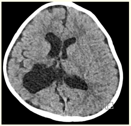 Figure 4: Post-operative CT scan brain showed significant regression of bilateral subdural hematoma with mild asymmetrical dilatation of the lateral ventricles.