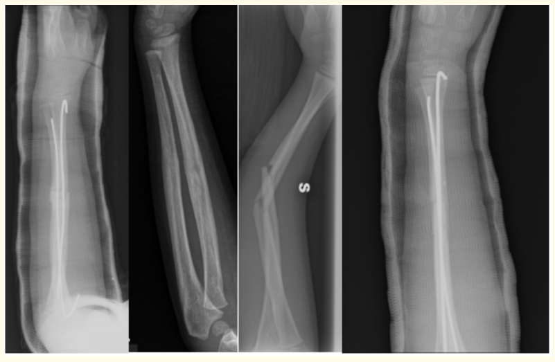 Figure 1: Fracture and healing then refracture and new treatment.