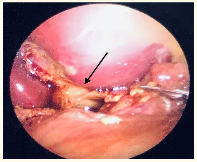 Figure 3: Laparoscopic picture: a false cyst of the common hepatic duct has formed in the area of the liver gate (shown by a black arrow). The surrounding tissues are imbibed with bile. Laparoscopic image: a false cyst of the common hepatic duct formed in the area of the liver gate (shown by a black arrow). The surrounding tissues are soaked with bile.