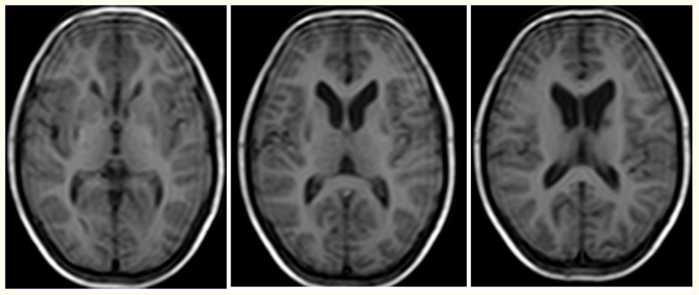 Figure 2: (A-C): Axial T1W MRI images reveal small focal hypo intensities in bilateral basal ganglia of a 13 years old male with WD.