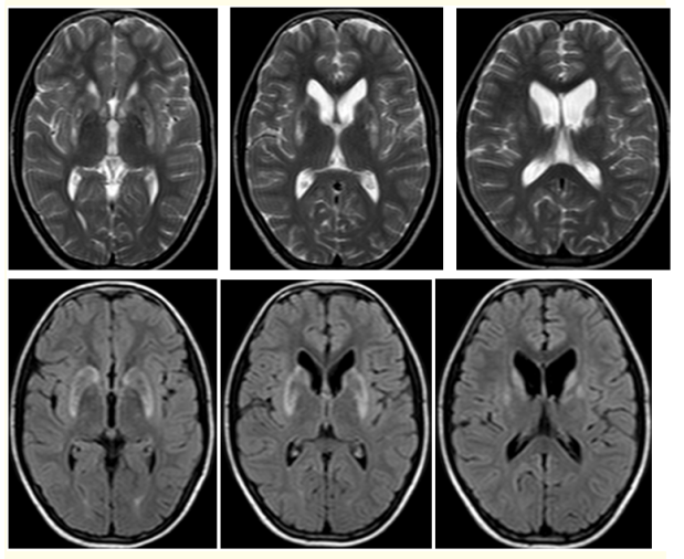 Figure 3: (A-F): T2W Axial (A-C): and FLAIR. (D-F): MR images show small focal hypo intensities with minimal surrounding hyperintensities in bilateral basal ganglia of a 13 old male patient with WD.