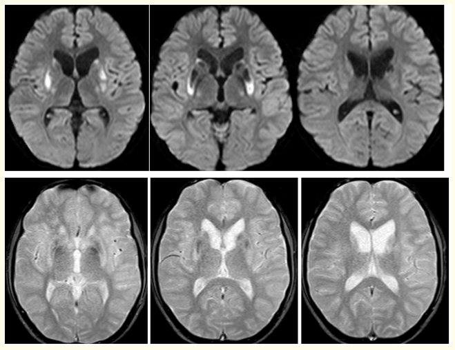 Figure 4: ( A-F): DWI (A-C): Show small focal hypointensities with minimal surrounding area of restricted diffusion in bilateral basal ganglia and T2W gradient echo images. (D-F): Reveal small focal areas of blooming in bilateral basal ganglia of a 13 years old male patient with WD.