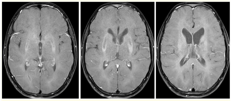 Figure 5: (A-C) Contrast enhanced MR axial images did not show any enhancing lesions of Basal ganglia in a 13 year old patient with WD.