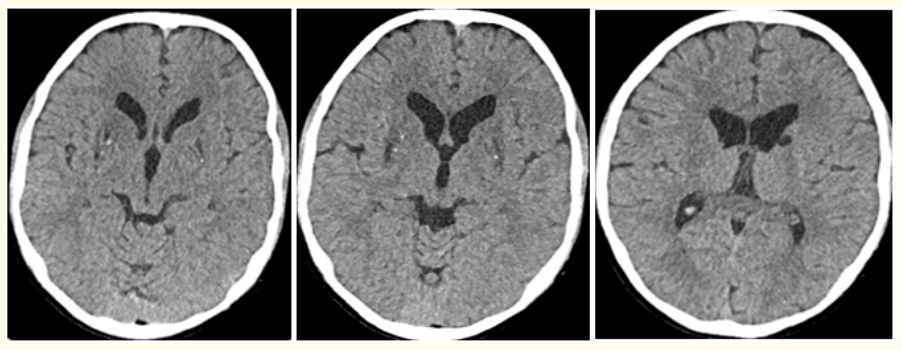 Figure 6: (A-C): Axial Computed tomography (CT) images of Brain of 13 years old male patient with WD shows small focal hypodensities in bilateral basal ganglia with tiny calcifications in bilateral lentiform nucleus.