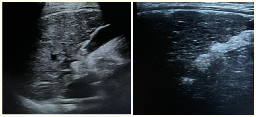 Figure 7: (A,B)Ultrasound image of 13 years old male patient with WD, showing coarse altered heterogenous echotexture of liver with nodular surface contours.