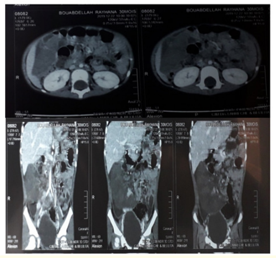 Figure 1: CT scan showing a swelling ectopic spleen within the right flank.