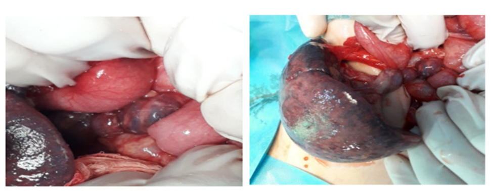 Figure 2: Intraoperative photo showing the torsion of vascular pedicle.