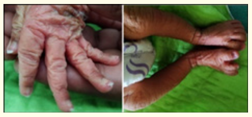 Figure 2: Icthyosis of skin with wrinkling and peeling in upper and lower limbs at birth.