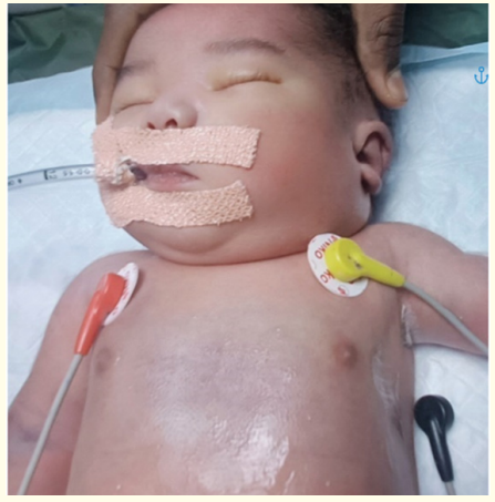 Figure 1: Clinical picture demonstrating subcutaneous
emphysema of anterior chest wall, neck and facial edema.
