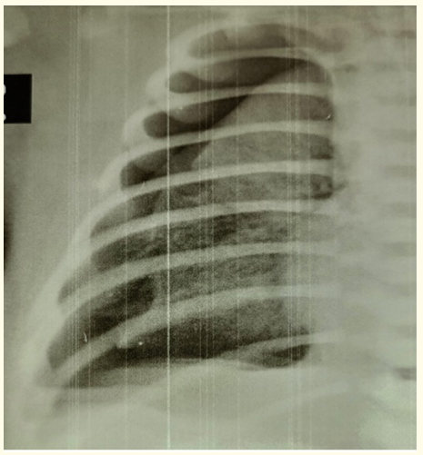 Figure 3: Radiograph of right lung showing gingko leaf
sign-gas outlining the pectoralis muscle.